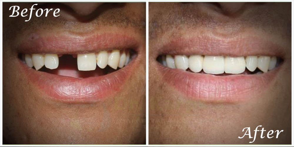 Correction Of Stained Teeth With Composite