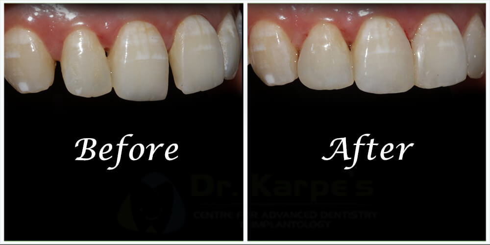 Correction Of Stained Teeth With Composite