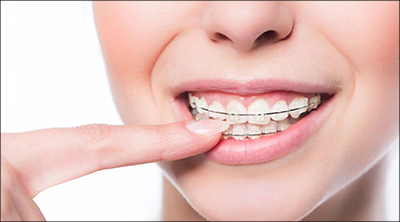 Orthodontic-Treatment